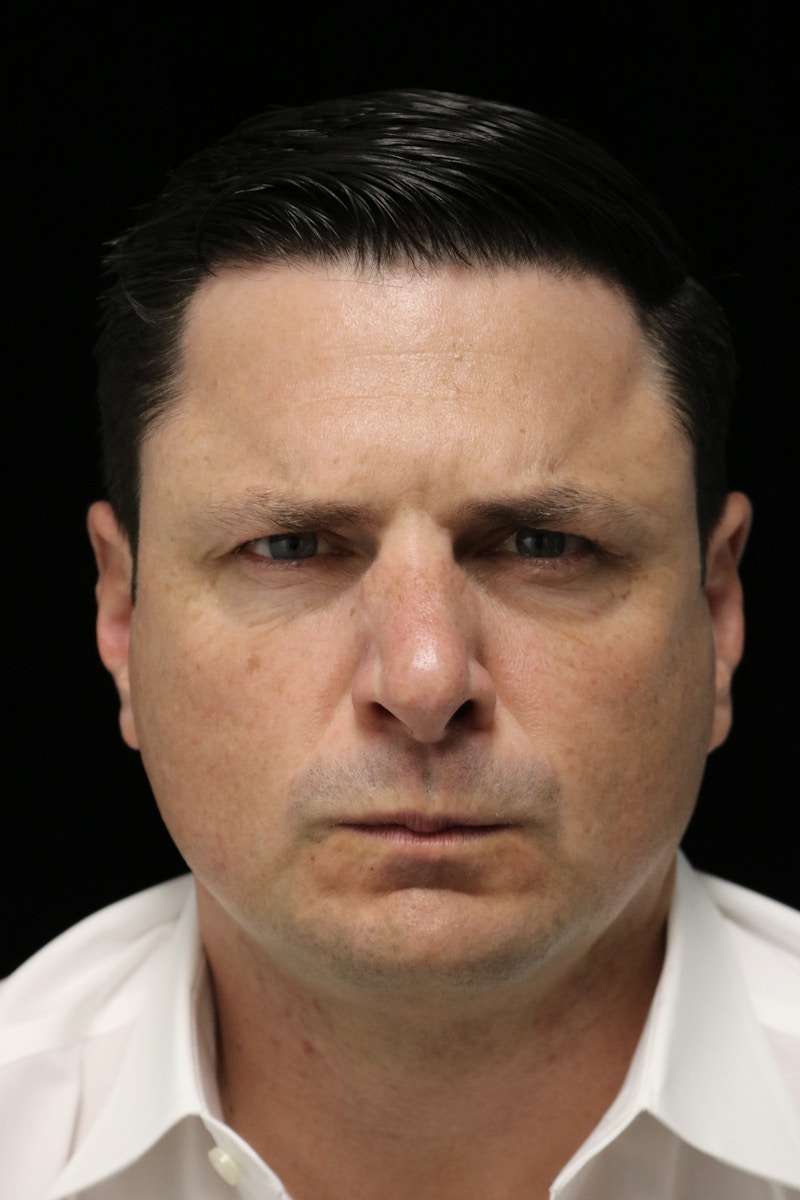 Beverly Hills Non-Surgical Before & After Gallery - Patient 406256 - Image 8 Dr. Deepak Raj Dugar