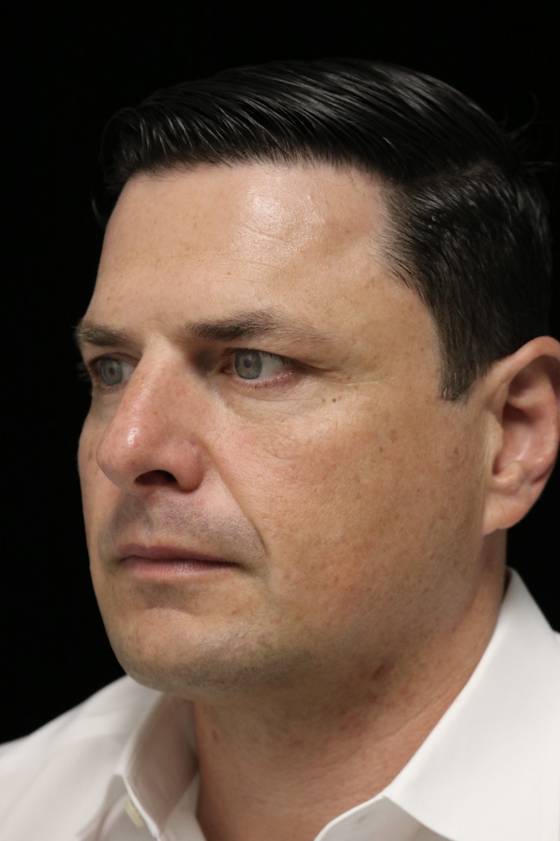 Beverly Hills Non-Surgical Before & After Gallery - Patient 406256 - Image 10 Dr. Deepak Raj Dugar