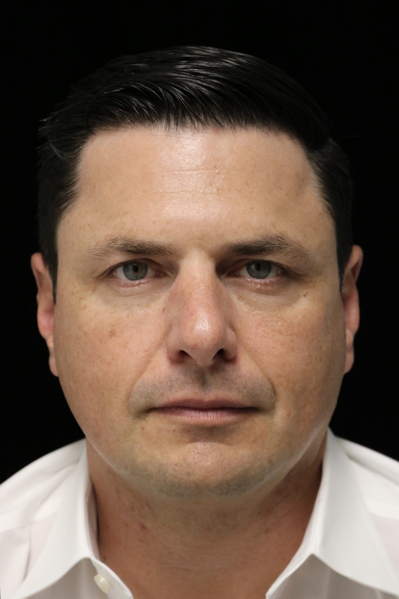 Beverly Hills Non-Surgical Before & After Gallery - Patient 406256 - Image 2 Dr. Deepak Raj Dugar