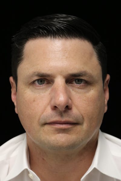 Beverly Hills Non-Surgical Before & After Gallery - Patient 406256 - Image 2 Dr. Deepak Raj Dugar