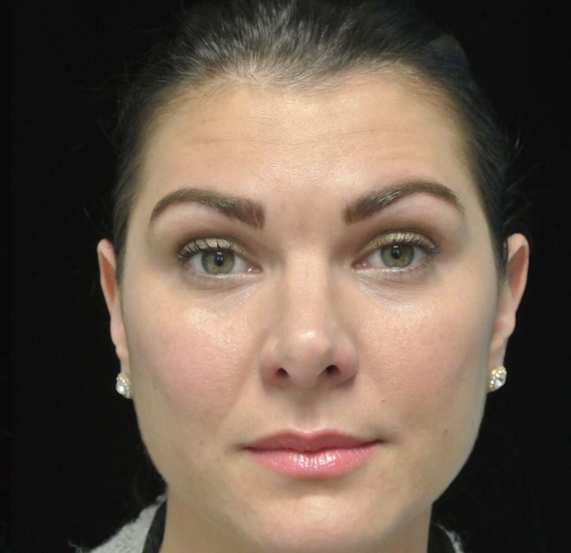 Beverly Hills Non-Surgical Before & After Gallery - Patient 307875 - Image 2 Dr. Deepak Raj Dugar