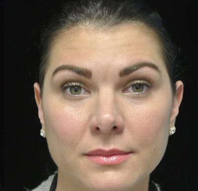 Beverly Hills Non-Surgical Before & After Gallery - Patient 307875 - Image 2 Dr. Deepak Raj Dugar