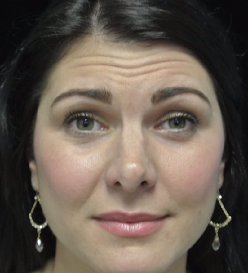 Beverly Hills Non-Surgical Before & After Gallery - Patient 307875 - Image 1 Dr. Deepak Raj Dugar