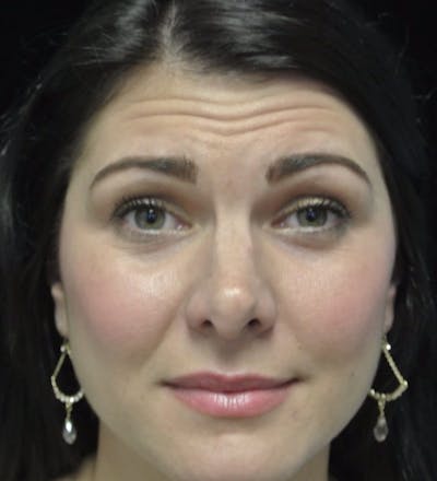 Beverly Hills Non-Surgical Before & After Gallery - Patient 307875 - Image 1 Dr. Deepak Raj Dugar