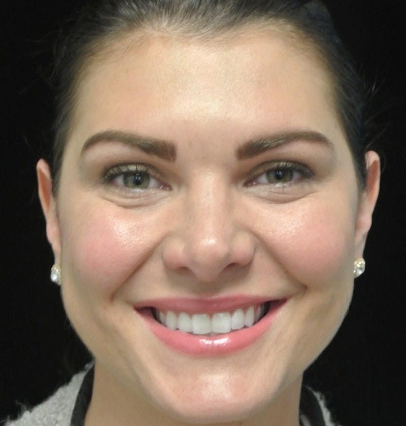 Beverly Hills Non-Surgical Before & After Gallery - Patient 307875 - Image 4 Dr. Deepak Raj Dugar
