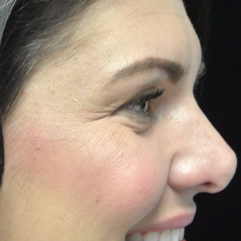 Beverly Hills Non-Surgical Before & After Gallery - Patient 307875 - Image 5 Dr. Deepak Raj Dugar