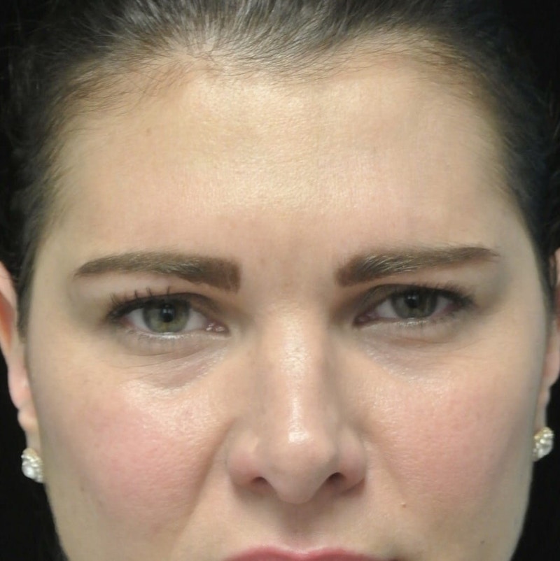 Beverly Hills Non-Surgical Before & After Gallery - Patient 307875 - Image 8 Dr. Deepak Raj Dugar