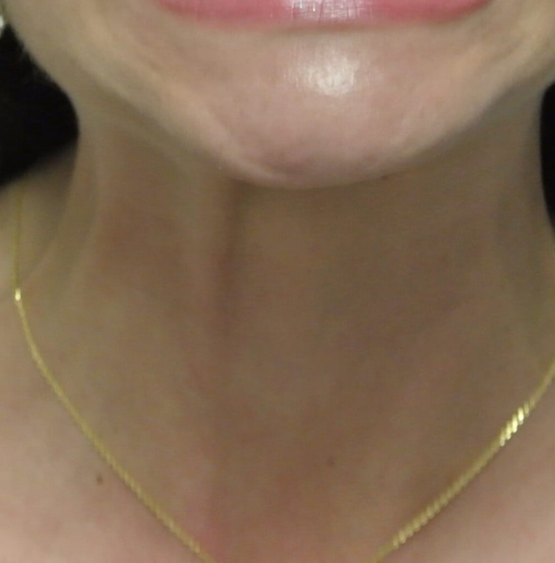 Beverly Hills Non-Surgical Before & After Gallery - Patient 307875 - Image 9 Dr. Deepak Raj Dugar