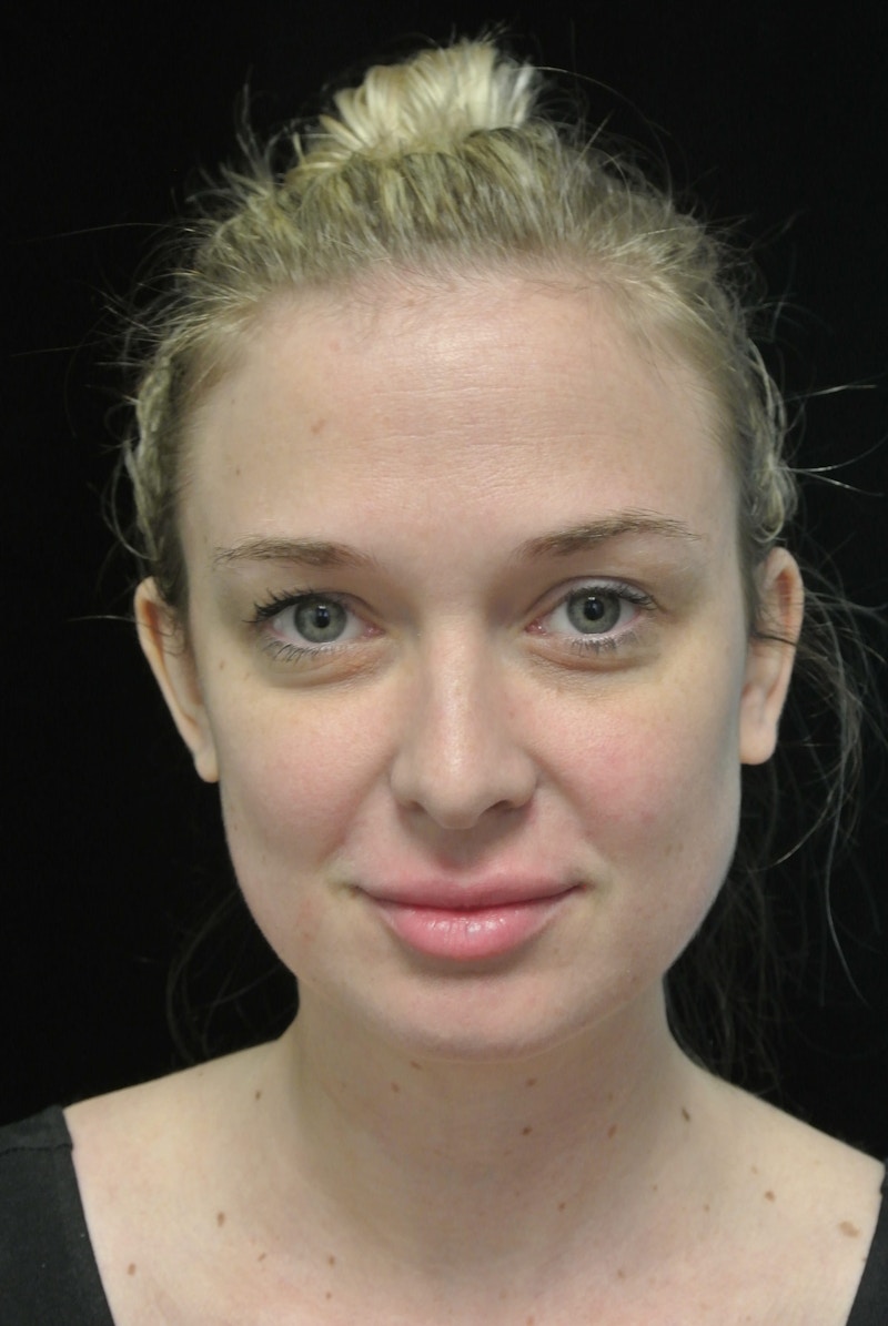 Beverly Hills Non-Surgical Before & After Gallery - Patient 334163 - Image 2 Dr. Deepak Raj Dugar