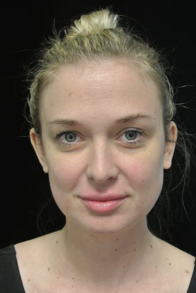 Beverly Hills Non-Surgical Before & After Gallery - Patient 334163 - Image 2 Dr. Deepak Raj Dugar
