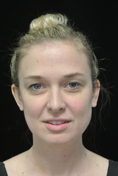 Beverly Hills Non-Surgical Before & After Gallery - Patient 334163 - Image 1 Dr. Deepak Raj Dugar
