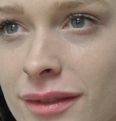 Beverly Hills Non-Surgical Before & After Gallery - Patient 169295 - Image 2 Dr. Deepak Raj Dugar