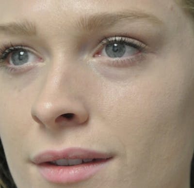 Beverly Hills Non-Surgical Before & After Gallery - Patient 169295 - Image 1 Dr. Deepak Raj Dugar