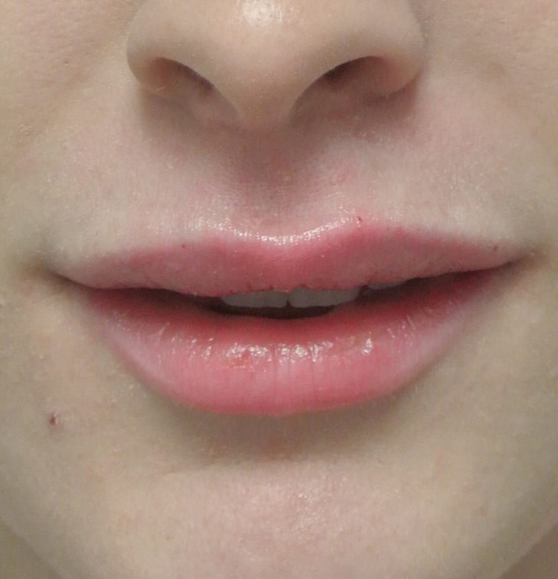 Beverly Hills Non-Surgical Before & After Gallery - Patient 169295 - Image 4 Dr. Deepak Raj Dugar