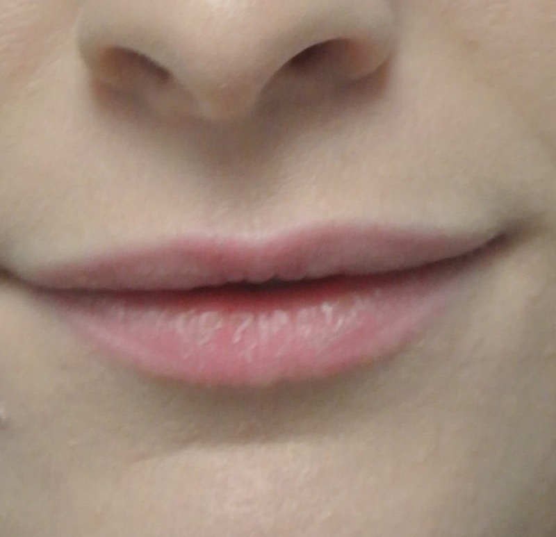 Beverly Hills Non-Surgical Before & After Gallery - Patient 169295 - Image 3 Dr. Deepak Raj Dugar