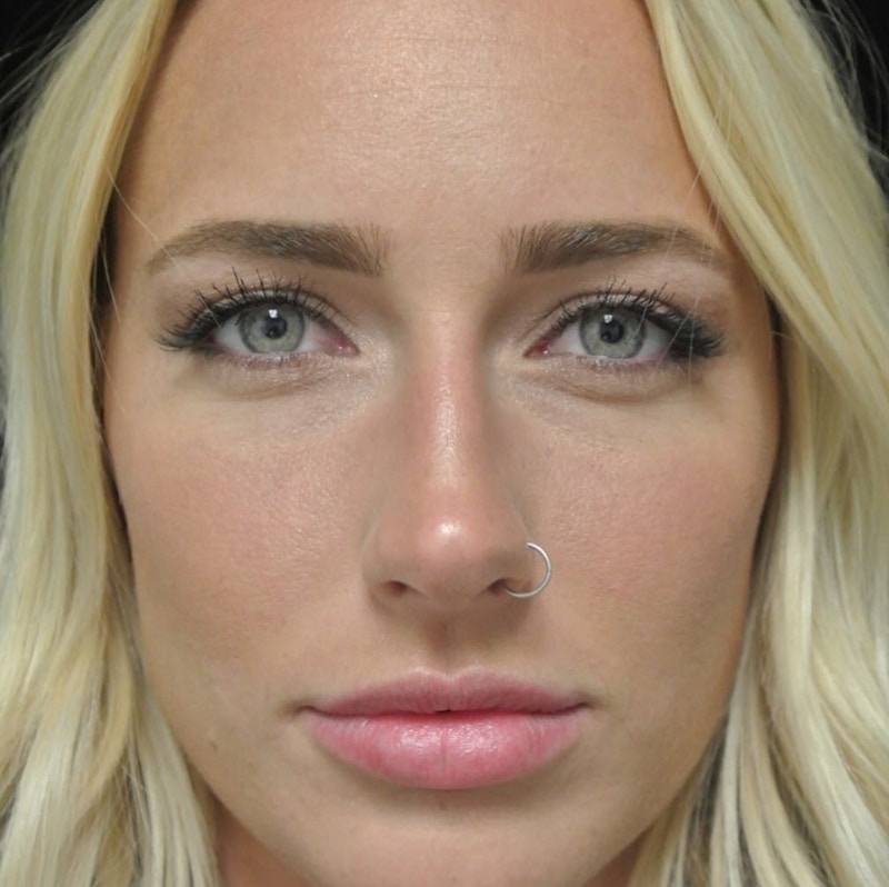 Beverly Hills Non-Surgical Before & After Gallery - Patient 912525 - Image 3 Dr. Deepak Raj Dugar