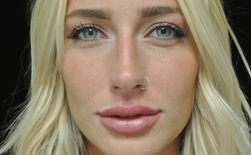 Beverly Hills Non-Surgical Before & After Gallery - Patient 912525 - Image 2 Dr. Deepak Raj Dugar