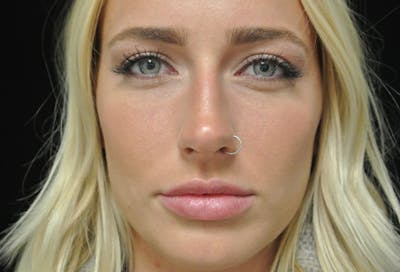 Beverly Hills Non-Surgical Before & After Gallery - Patient 912525 - Image 1 Dr. Deepak Raj Dugar