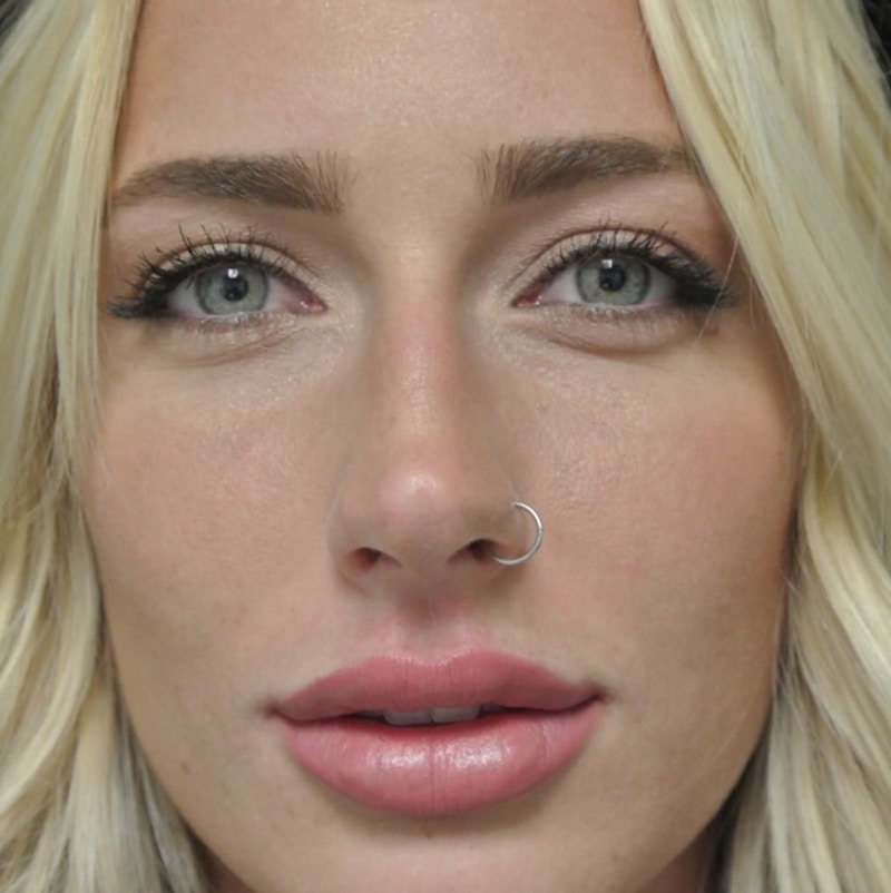 Beverly Hills Non-Surgical Before & After Gallery - Patient 912525 - Image 4 Dr. Deepak Raj Dugar