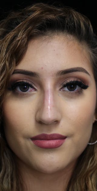 Beverly Hills Non-Surgical Rhinoplasty Before & After Gallery - Patient 417025 - Image 4 Dr. Deepak Raj Dugar
