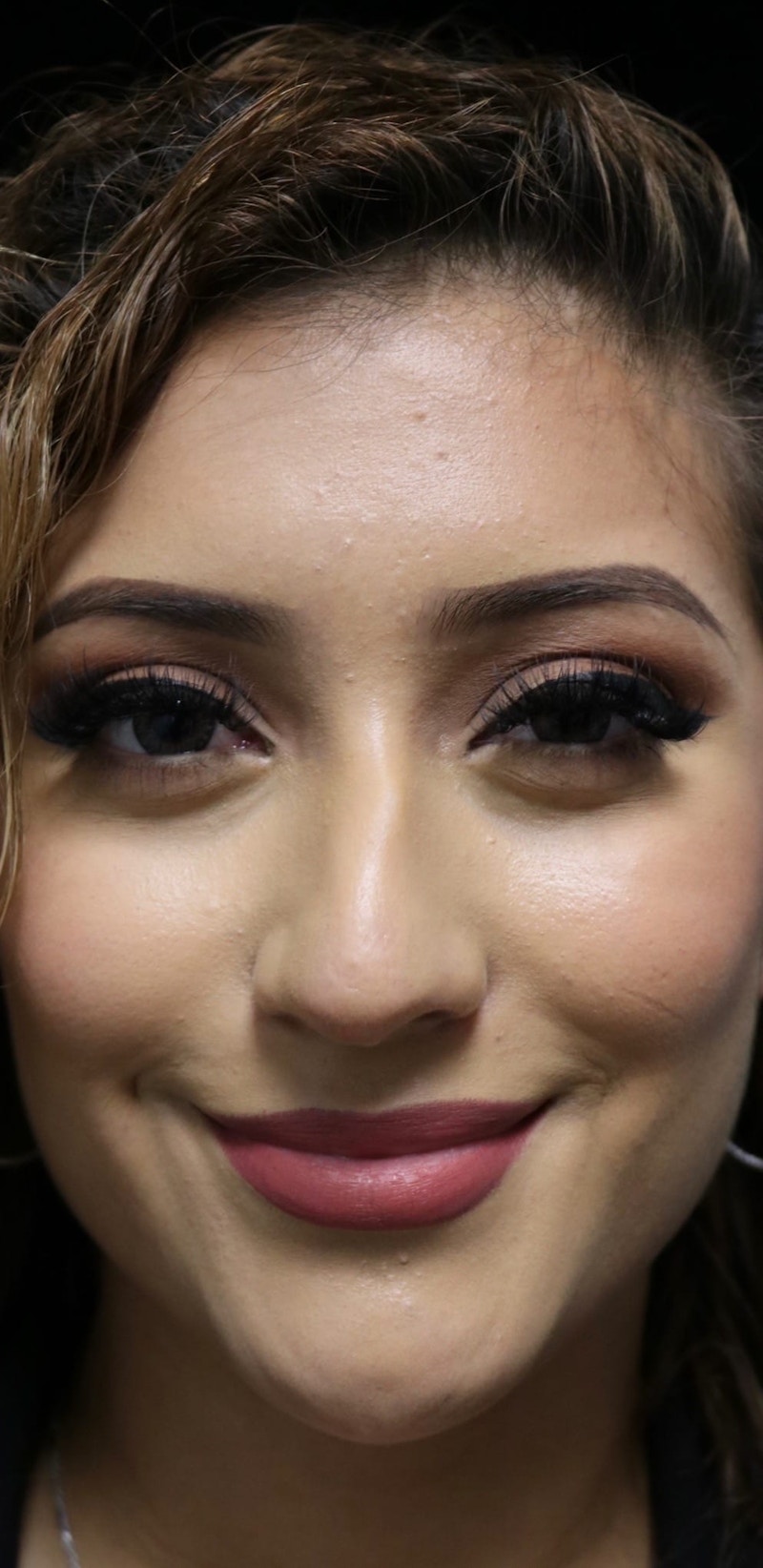 Beverly Hills Non-Surgical Rhinoplasty Before & After Gallery - Patient 417025 - Image 3 Dr. Deepak Raj Dugar