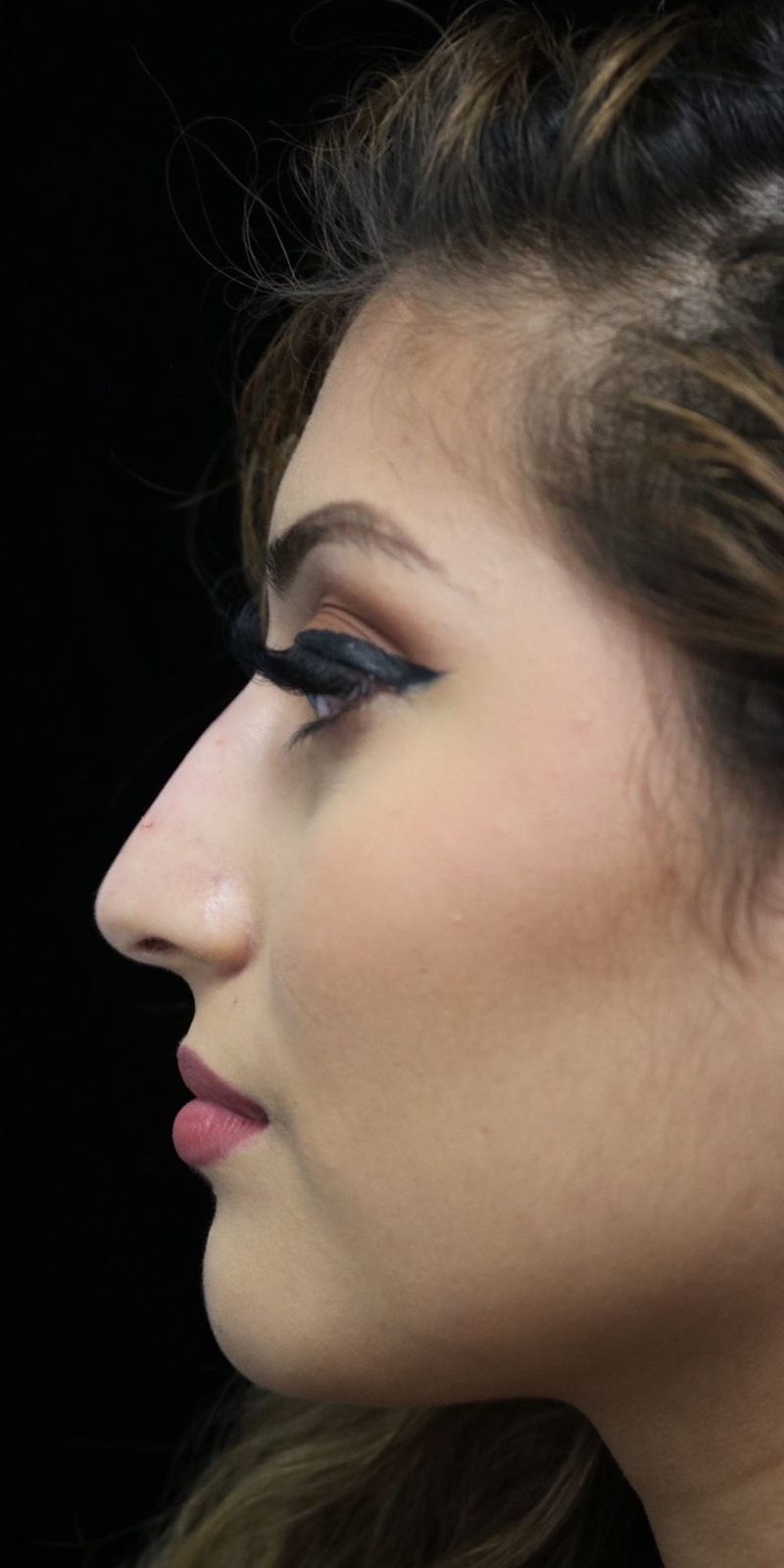 Beverly Hills Non-Surgical Rhinoplasty Before & After Gallery - Patient 417025 - Image 6 Dr. Deepak Raj Dugar