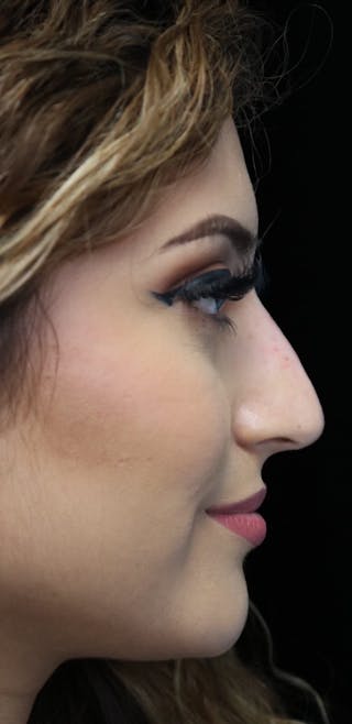 Beverly Hills Non-Surgical Rhinoplasty Before & After Gallery - Patient 417025 - Image 2 Dr. Deepak Raj Dugar