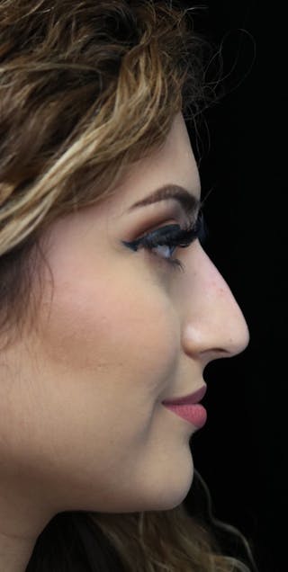 Beverly Hills Non-Surgical Rhinoplasty Before & After Gallery - Patient 417025 - Image 8 Dr. Deepak Raj Dugar