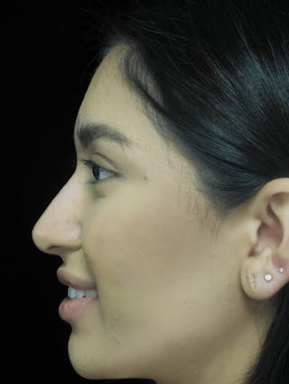 Beverly Hills Non-Surgical Rhinoplasty Before & After Gallery - Patient 350215 - Image 4 Dr. Deepak Raj Dugar