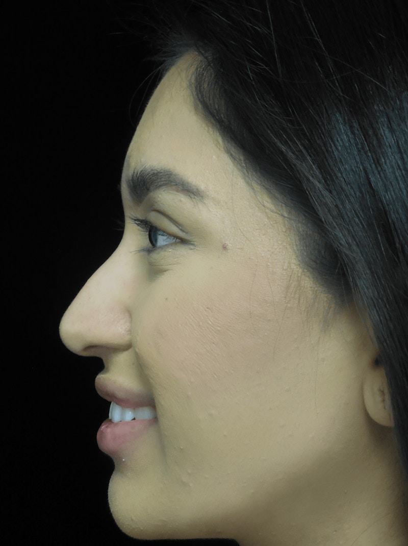Beverly Hills Non-Surgical Rhinoplasty Before & After Gallery - Patient 350215 - Image 3 Dr. Deepak Raj Dugar