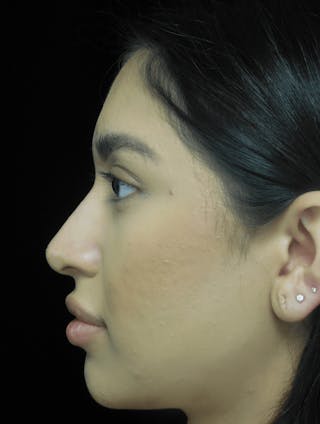 Beverly Hills Non-Surgical Rhinoplasty Before & After Gallery - Patient 350215 - Image 6 Dr. Deepak Raj Dugar