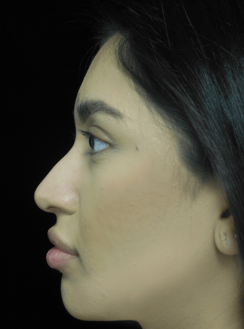 Beverly Hills Non-Surgical Rhinoplasty Before & After Gallery - Patient 350215 - Image 5 Dr. Deepak Raj Dugar