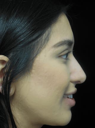 Beverly Hills Non-Surgical Rhinoplasty Before & After Gallery - Patient 350215 - Image 2 Dr. Deepak Raj Dugar