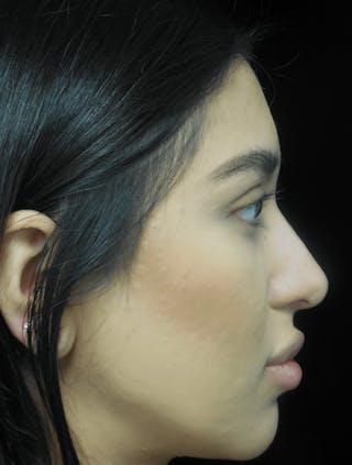 Beverly Hills Non-Surgical Rhinoplasty Before & After Gallery - Patient 350215 - Image 8 Dr. Deepak Raj Dugar