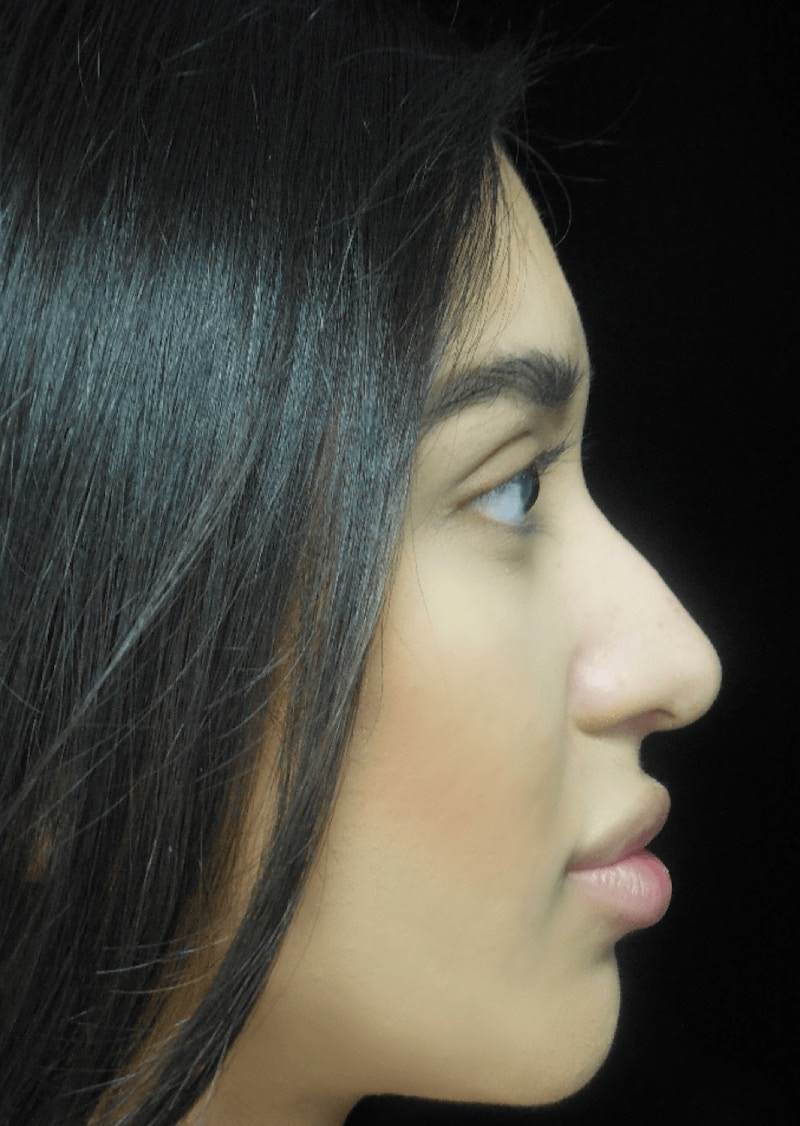 Beverly Hills Non-Surgical Rhinoplasty Before & After Gallery - Patient 350215 - Image 7 Dr. Deepak Raj Dugar