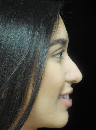 Beverly Hills Non-Surgical Rhinoplasty Before & After Gallery - Patient 350215 - Image 1 Dr. Deepak Raj Dugar