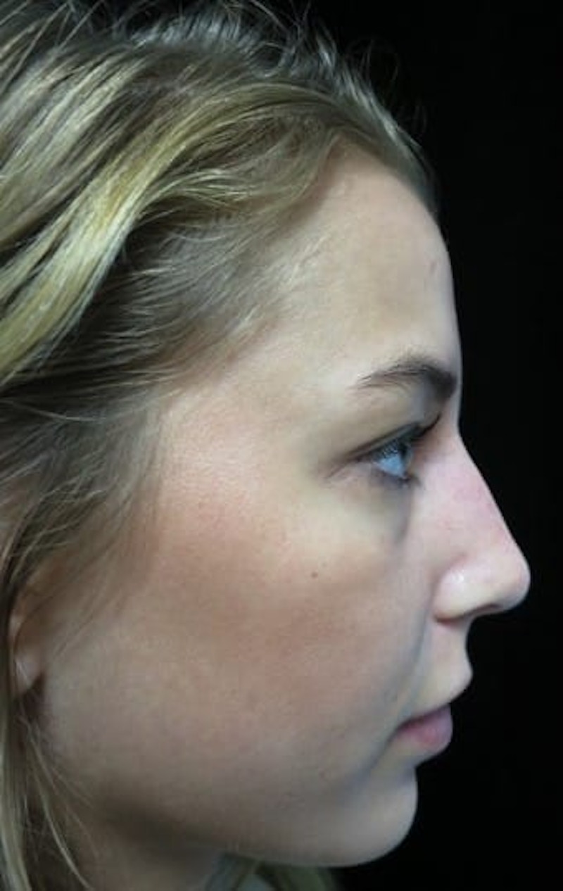 Beverly Hills Non-Surgical Rhinoplasty Before & After Gallery - Patient 151149 - Image 2 Dr. Deepak Raj Dugar