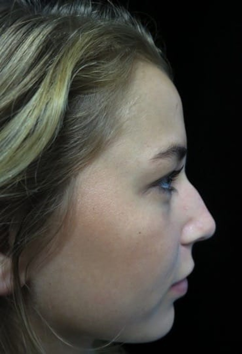 Beverly Hills Non-Surgical Rhinoplasty Before & After Gallery - Patient 151149 - Image 1 Dr. Deepak Raj Dugar