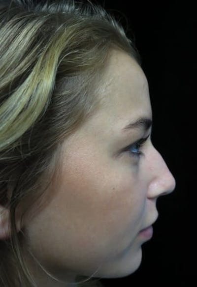 Beverly Hills Non-Surgical Rhinoplasty Before & After Gallery - Patient 151149 - Image 1 Dr. Deepak Raj Dugar