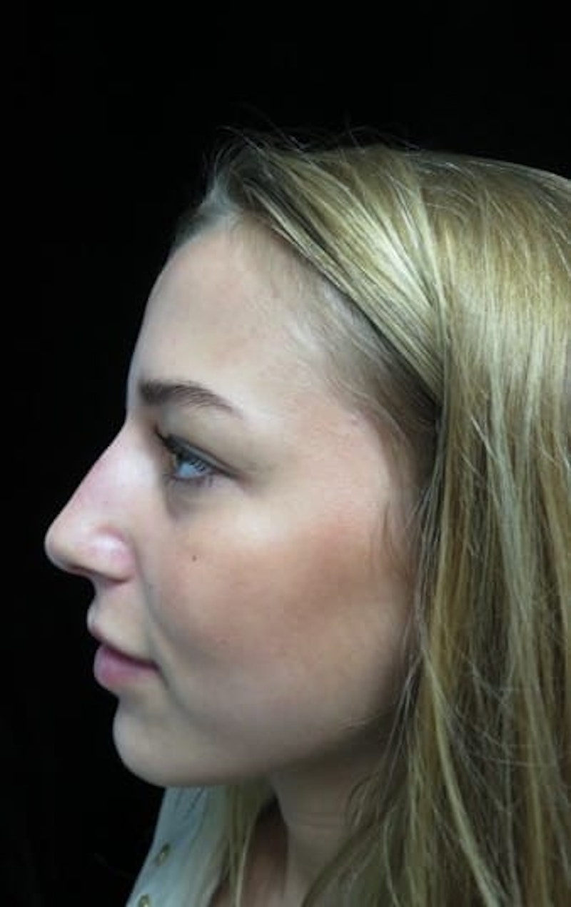 Beverly Hills Non-Surgical Rhinoplasty Before & After Gallery - Patient 151149 - Image 4 Dr. Deepak Raj Dugar