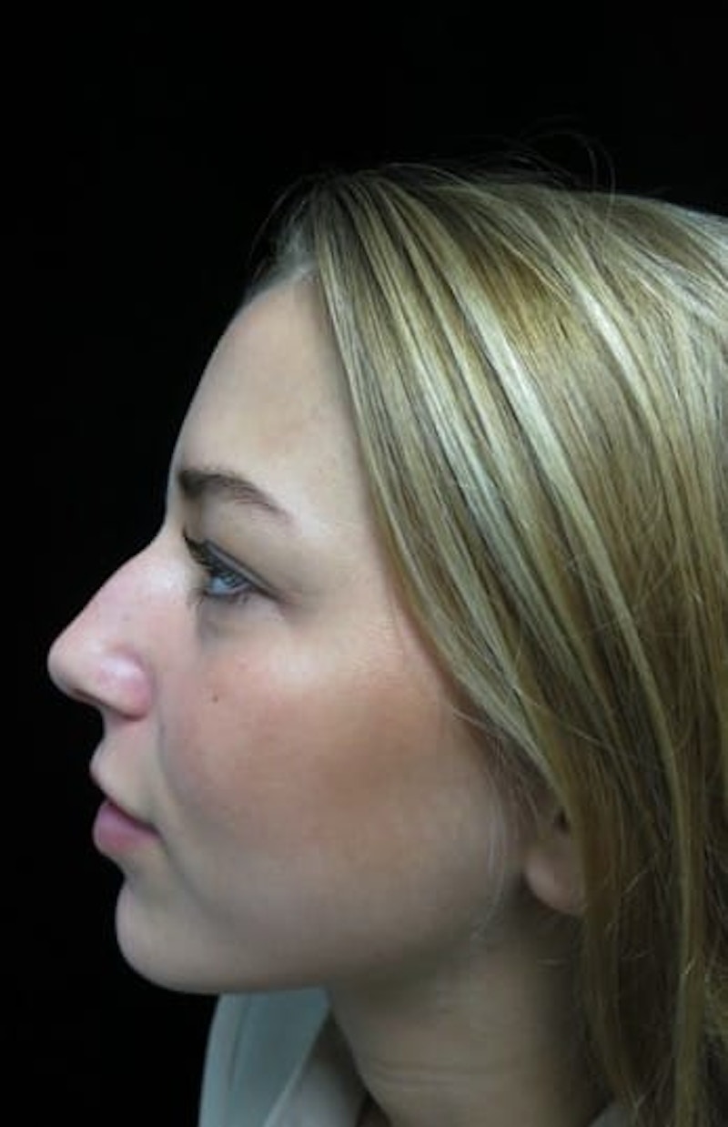 Beverly Hills Non-Surgical Rhinoplasty Before & After Gallery - Patient 151149 - Image 3 Dr. Deepak Raj Dugar