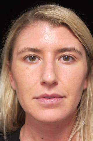 Beverly Hills Rhinoplasty Before & After Gallery - Patient 109427 - Image 4 Dr. Deepak Raj Dugar