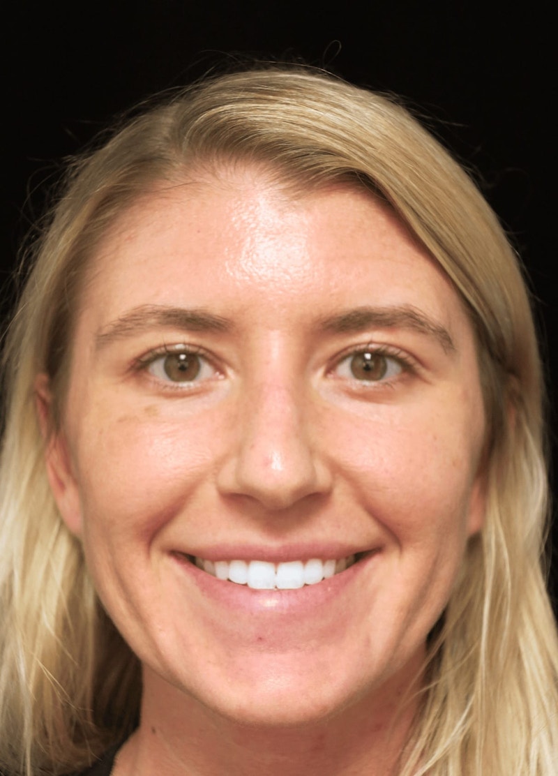 Beverly Hills Rhinoplasty Before & After Gallery - Patient 109427 - Image 6 Dr. Deepak Raj Dugar
