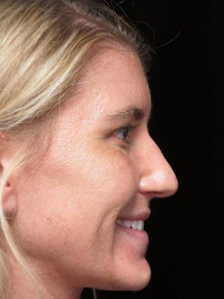 Beverly Hills Rhinoplasty Before & After Gallery - Patient 109427 - Image 10 Dr. Deepak Raj Dugar