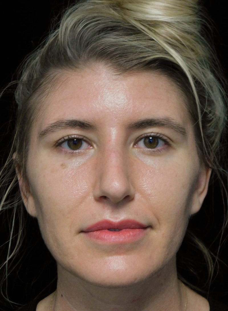 Beverly Hills Rhinoplasty Before & After Gallery - Patient 109427 - Image 3 Dr. Deepak Raj Dugar