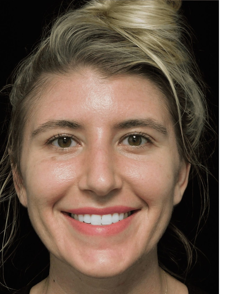 Beverly Hills Rhinoplasty Before & After Gallery - Patient 109427 - Image 5 Dr. Deepak Raj Dugar