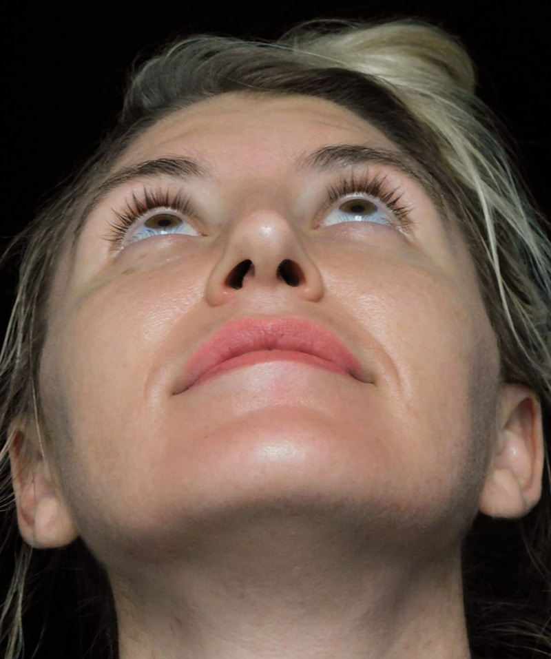 Beverly Hills Rhinoplasty Before & After Gallery - Patient 109427 - Image 7 Dr. Deepak Raj Dugar