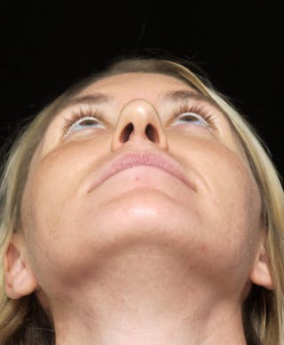 Beverly Hills Rhinoplasty Before & After Gallery - Patient 109427 - Image 8 Dr. Deepak Raj Dugar