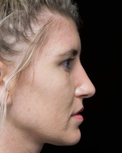 Beverly Hills Rhinoplasty Before & After Gallery - Patient 109427 - Image 1 Dr. Deepak Raj Dugar