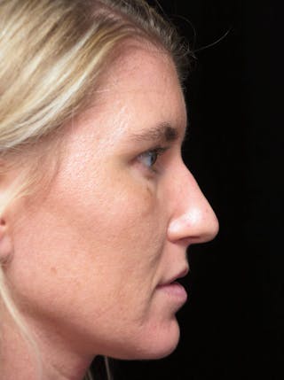 Beverly Hills Rhinoplasty Before & After Gallery - Patient 109427 - Image 2 Dr. Deepak Raj Dugar